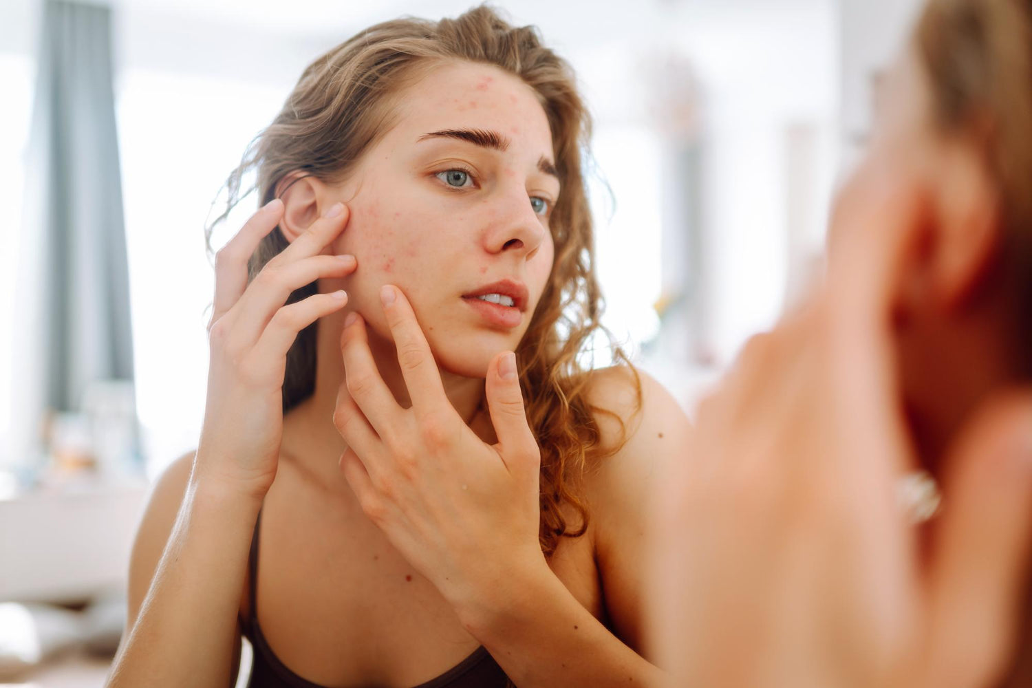 Stop Spring Breakouts Before They Start!