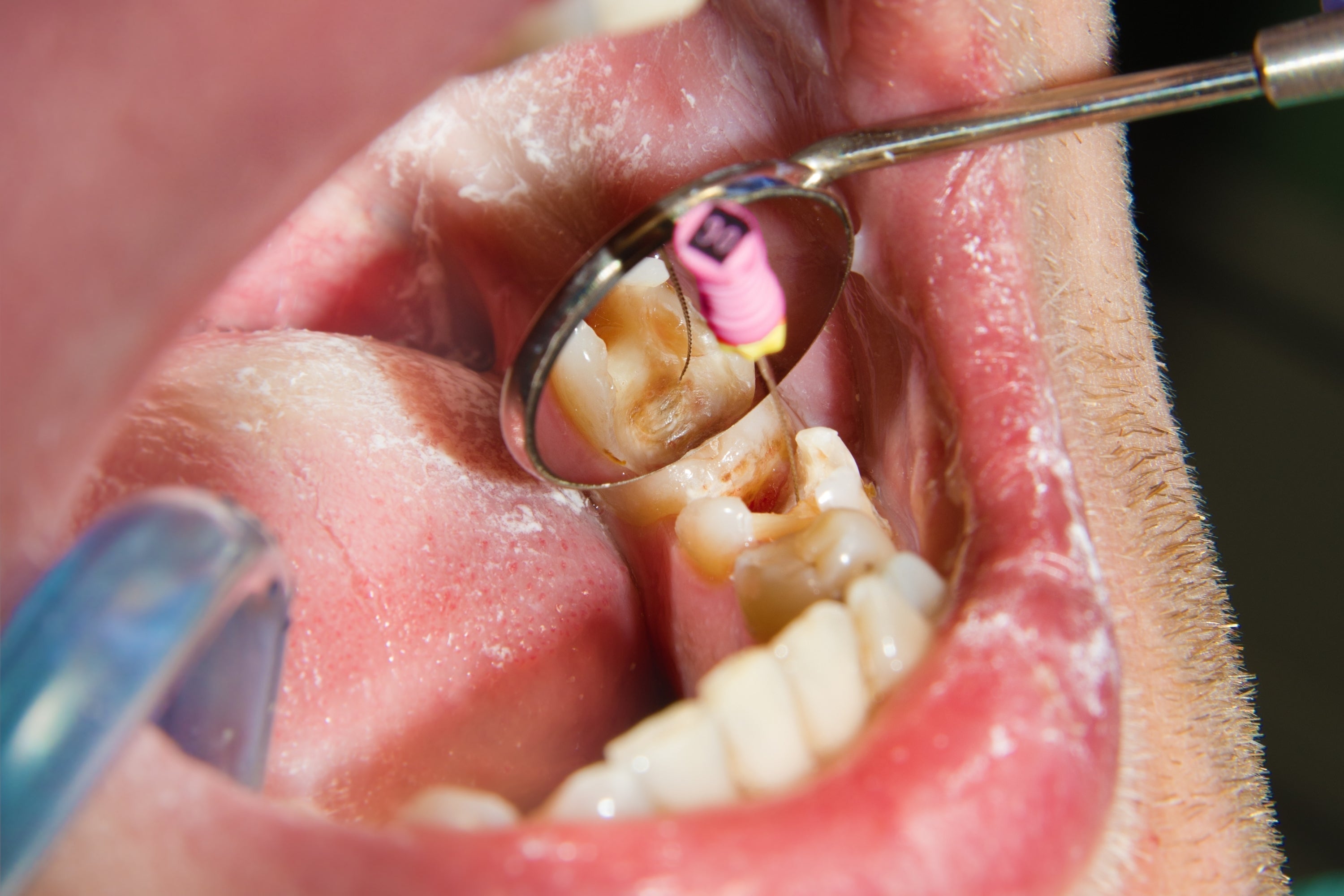 Reversing Cavities? The Secret You Need To Know!