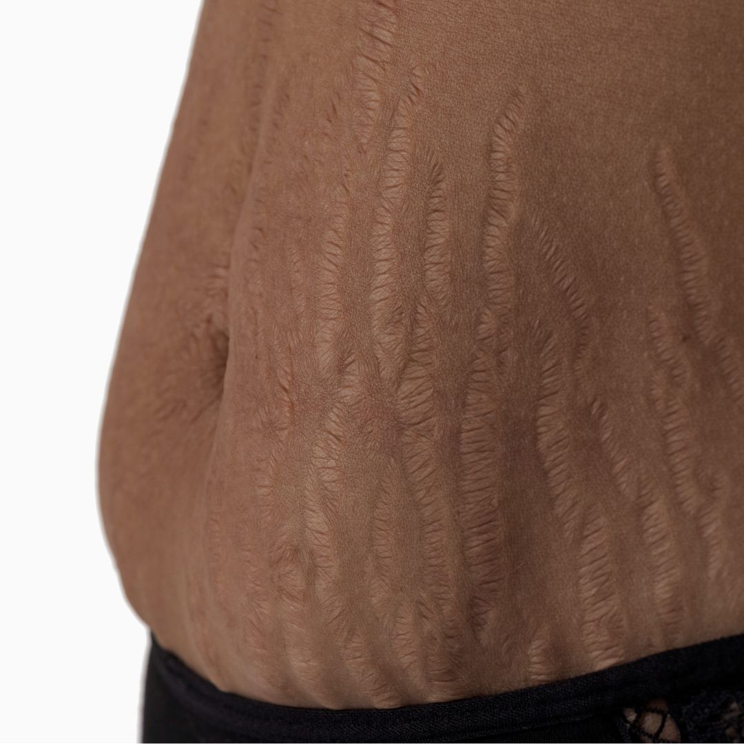 What Are Stretch Marks, and How To Get Rid Of Them Today!