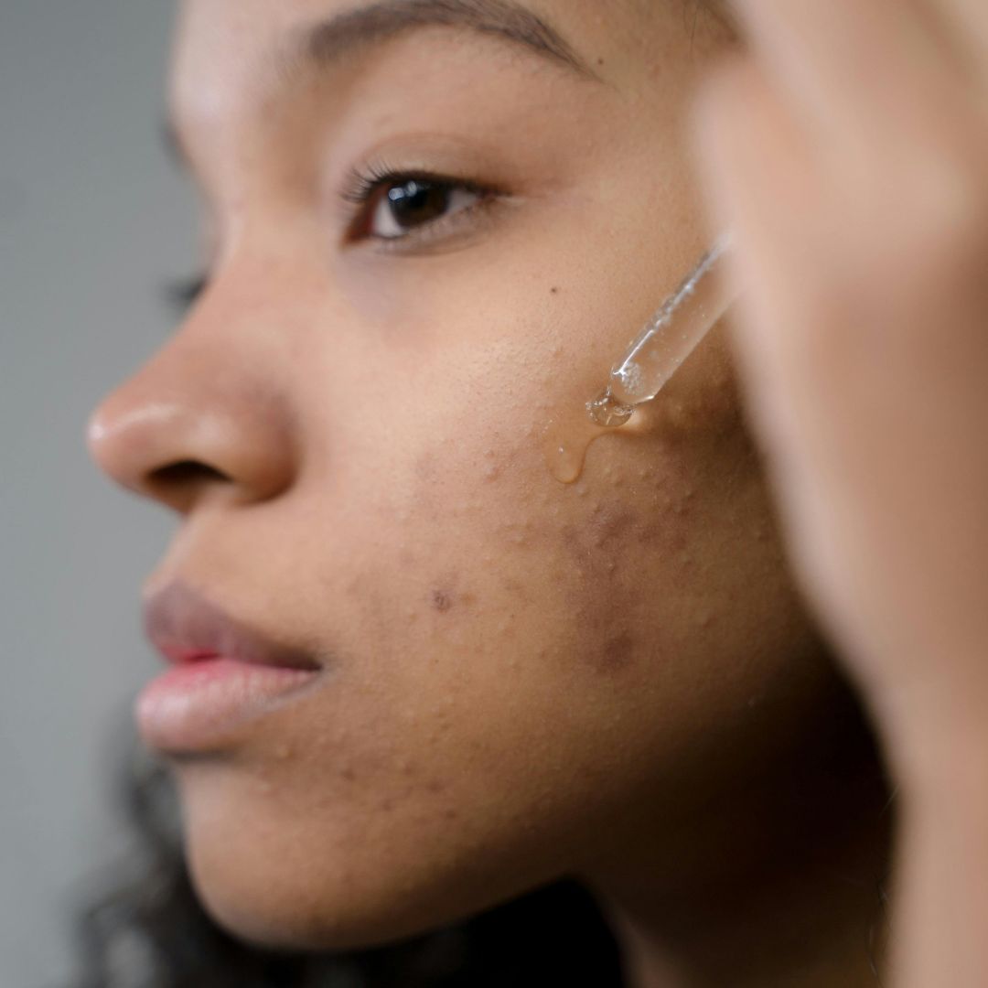 What Is 4D Hyaluronic Acid and Why You Should Start Using It Today!