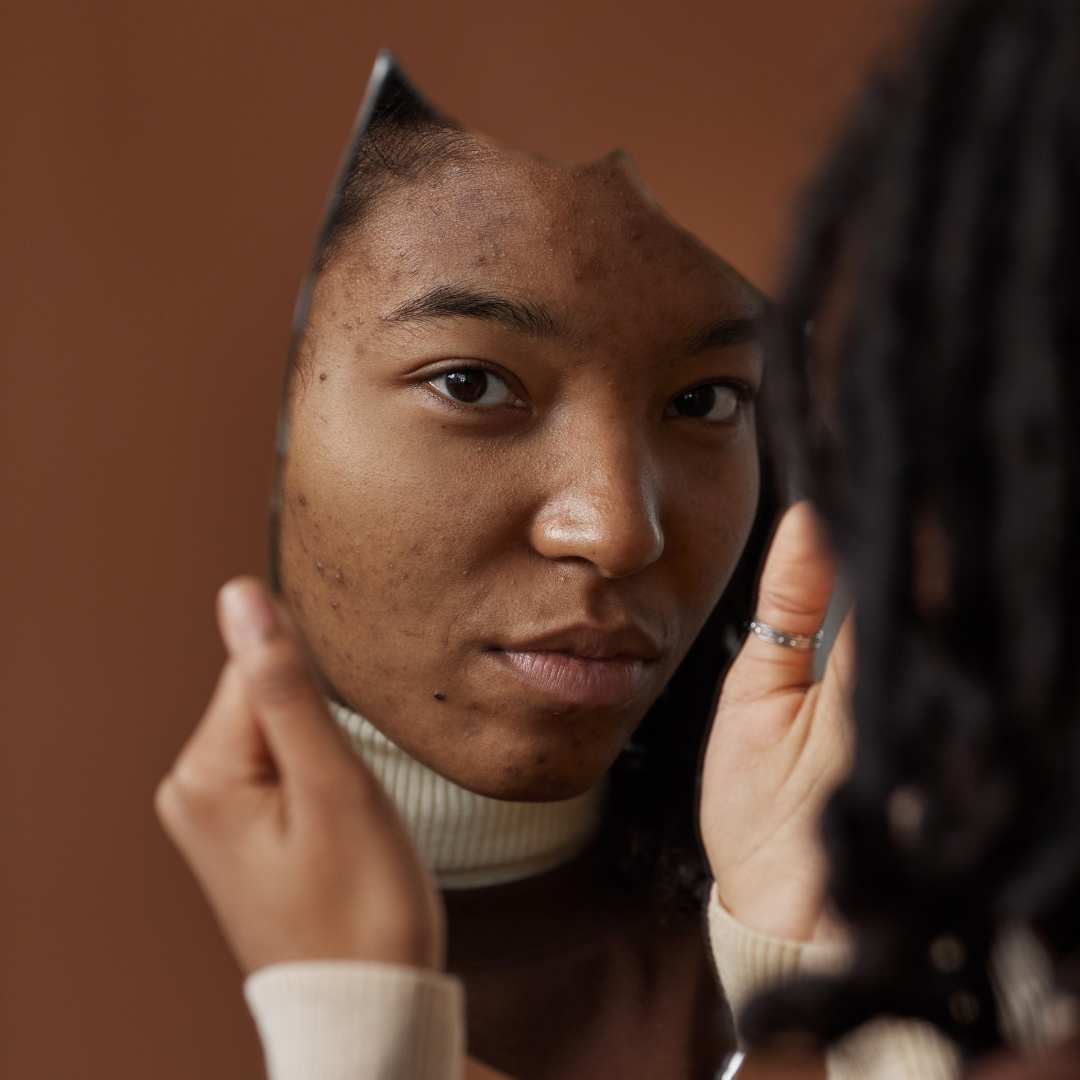 4 Ways To Remedy Acne Scars Today!